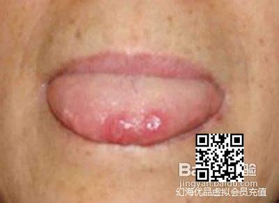 舌头溃疡的治疗方法